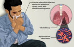 Thumbnail for Tuberculosis in India