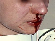 [1] eine Frau mit Nasenbluten