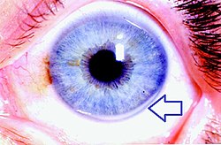 Four examples of cholesterol deposits at the outer edge of the cornea.[7]