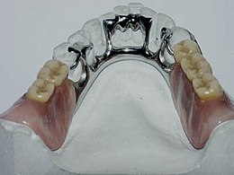 Wat Adviseur krijgen Prothese (tandheelkunde) - Wikipedia