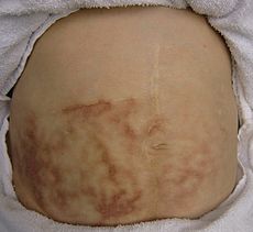 Medical Definition of Toasted skin syndrome - MedicineNet