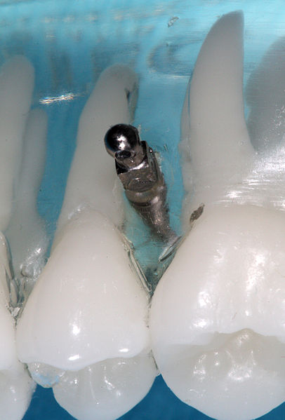 File:Implant orthodontic anchor model.jpg
