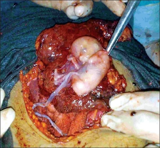 Abdominal pregnancy form of an ectopic pregnancy where the embryo or fetus is growing and developing outside the womb in the abdomen, but not in the Fallopian tube, ovary or broad ligament