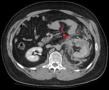Abdominal CT showing left renal artery injury Leftrenalarteryinjury.png
