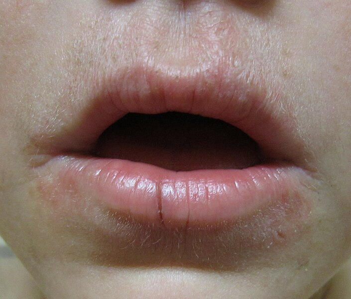 File:Lip licker's dermatitis 2.jpg