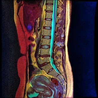 Magnetic Resonance Image of Lumbar Spine courtesy of Nevit Dilmen Lumbar MRI T1FSE T2frFSE STIR 09.jpg