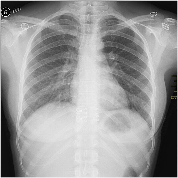 File:Medical X-Ray imaging RWI07 nevit.jpg