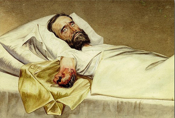 Confederate Army Private Milton E. Wallen lies in bed with a gangrenous amputated arm