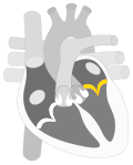 Thumbnail for Mitral annular disjunction