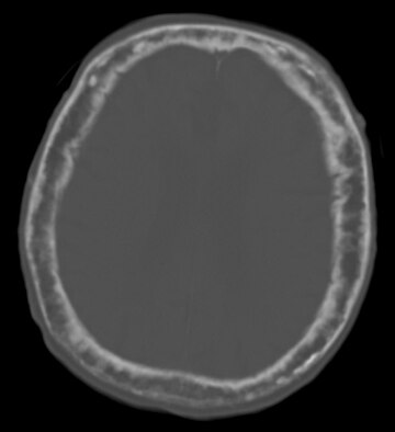 Paget's disease of bone