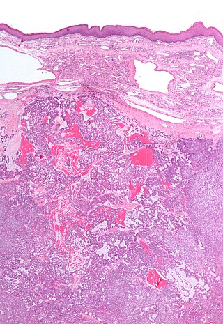 <span class="mw-page-title-main">Polymorphous low-grade adenocarcinoma</span> Medical condition