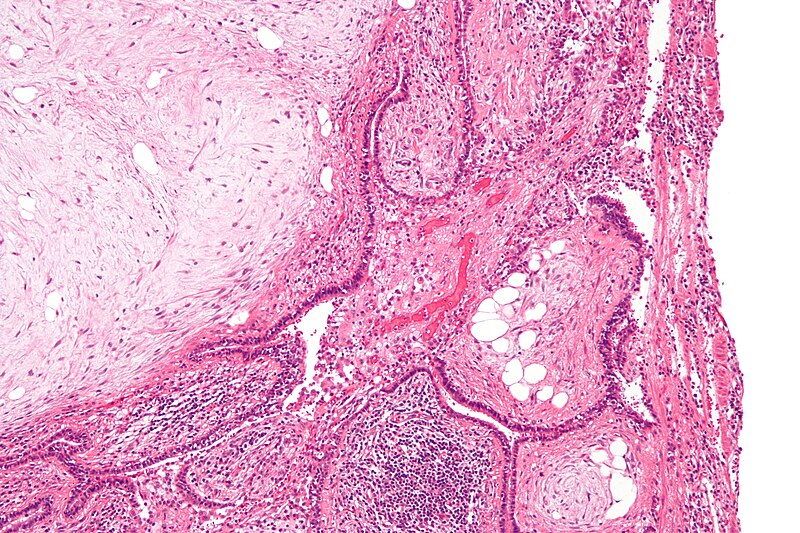 File:Pulmonary hamartoma - intermed mag.jpg