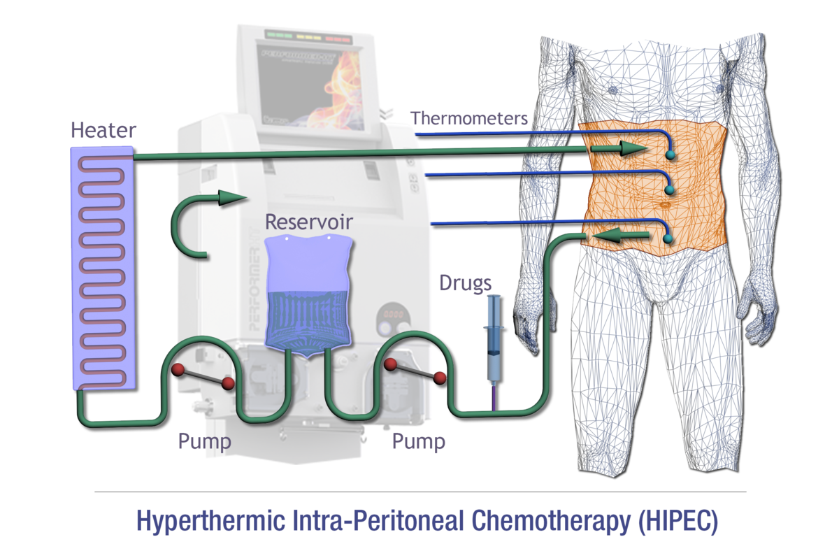 Chemo pump: Definition and how they work