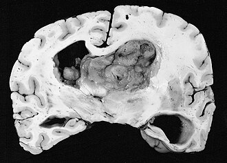 Photograph of a brain section containing a subependymal giant cell astrocytoma Sega gross.jpg