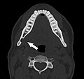 Stafne bone cavity seen on axial CT
