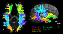 Figure 2: Diffusion tensor imaging example The diffusion tensor tractographies of neural tracts for language fnhum-07-00749-g001.png