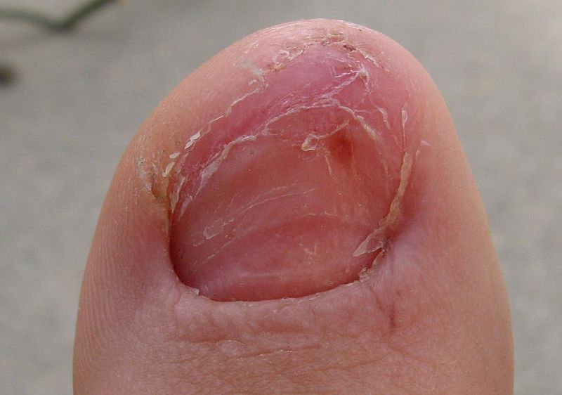File:Toe Without Nail.JPG