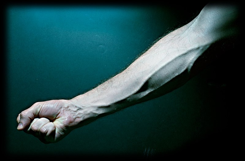 tratamentul pskom varicoz cum arata un picior dupa o operaie varicoasa