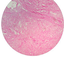 adenocarcinoma prostata gleason 43 Gyertyák a gyulladás emelésére a prosztatitis