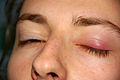 Chalazion.