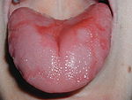 Geographic Tongue.jpg