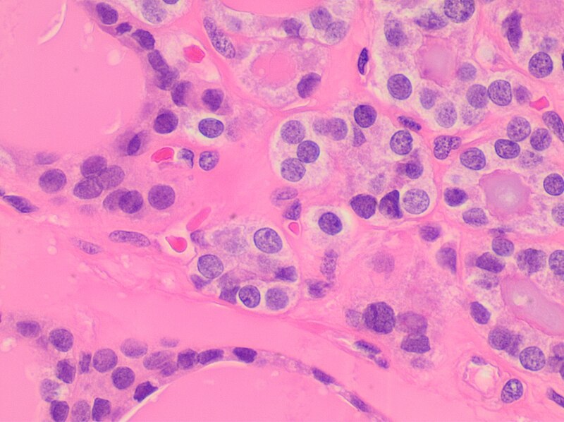 File:Histopathology of diffuse hypercellular hyperplastic focus of thyroid, high magnification.jpg