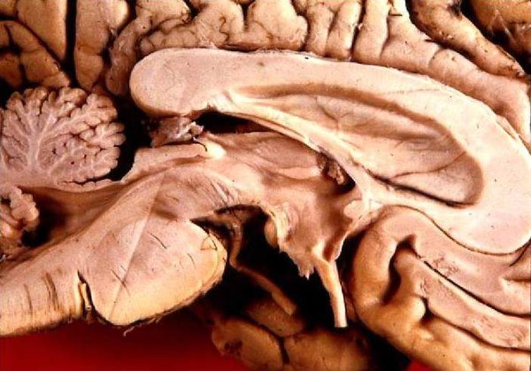 Human brain left midsagitttal view closeup.JPG
