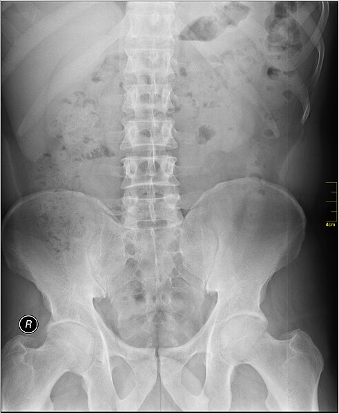 File:Medical X-Ray imaging VKI07 nevit.jpg