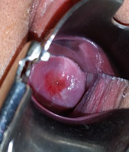 Nulliparous cervix with ectropion