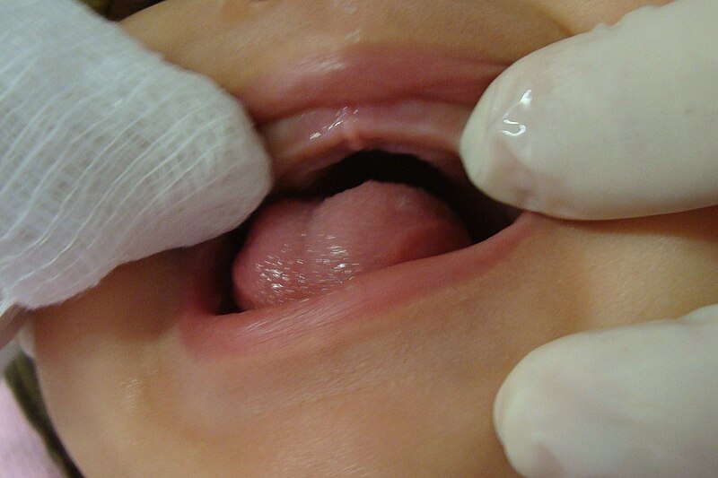 File:Oral hygiene with gauze.jpg