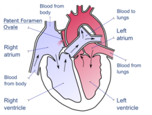 atrial septal defect