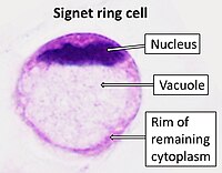 Signet ring cell.jpg