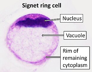 Zegelringcel, zoals te zien bij een colonadenocarcinoom met een vacuole van mucine.