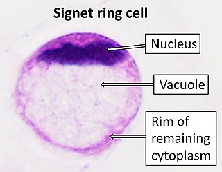 <span class="mw-page-title-main">Signet ring cell carcinoma</span> Medical condition