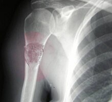 Telangiectactic osteosarcoma of the humerus