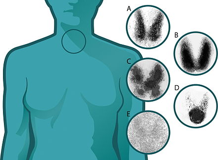 Thyroid Disease Wikiwand