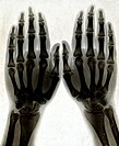 X-ray of Norah Schuster's hands by her father