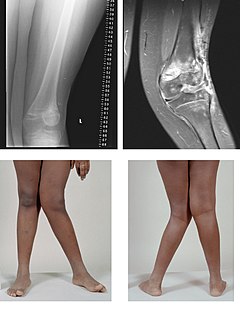 Valgus deformity Deformity in which the bone near a joint is angled outward