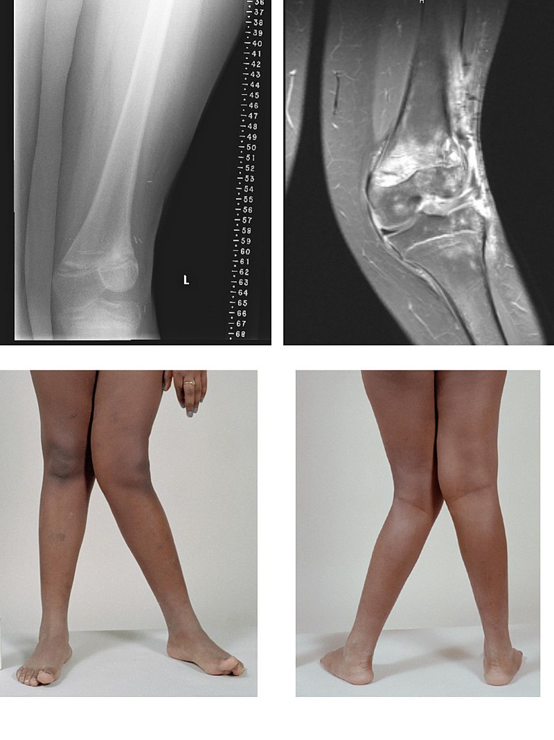 Leg bone - Wikipedia