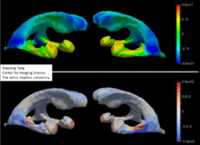 Shown are shape templates of amygdala, hippocampus, and ventricle generated from 754 ADNI samples` Top panel denotes the localized surface area group differences between normal aging and Alzheimer disease (positive represents atrophy in Alzheimer whereas negative suggests expansion). Bottom panel denotes the group differences in the annualized rates of change in the localized surface areas (positive represents faster atrophy rates (or slower expansion rates) in Alzheimer whereas negative suggests faster expansion rates (or slower atrophy rates) in Alzheimer); taken from Tang et al. Xiaoying Tang ADNI template.png