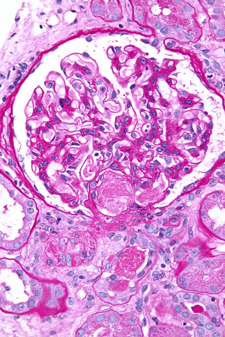 صورة مجهرية showing an acute thrombotic microangiopathy, the علم الأنسجة correlate of DIC, in a خزعة كلوية. A خثرة is present in the نقير of the كبيبة (توضيح) (center of image). PAS stain.