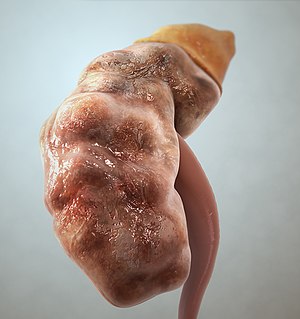 CKD - Chronic kidney disease.jpg