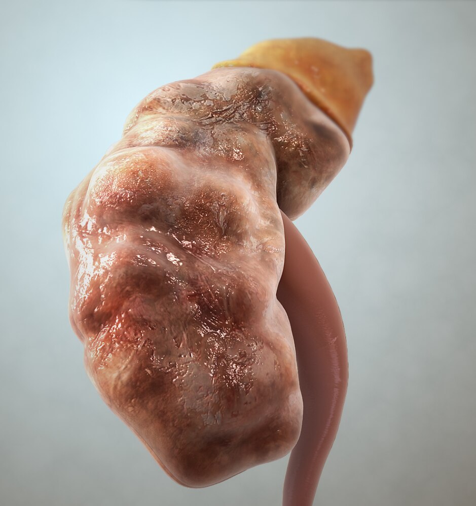 Chronic Kidney Disease-avatar