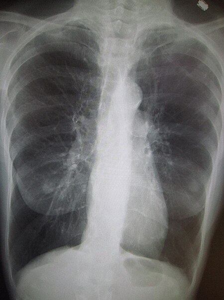 ไฟล์:COPD.JPG