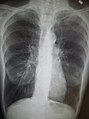 Radiografia torácica de DPOC grave, em que se observa o tamanho relativamente pequeno do coração em relação aos pulmões.