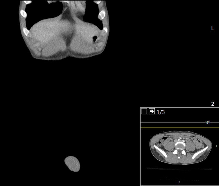 CT of a normal abdomen and pelvis, coronal plane 17.png