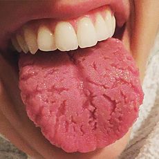Causes of Fissured tongue - RightDiagnosis.com