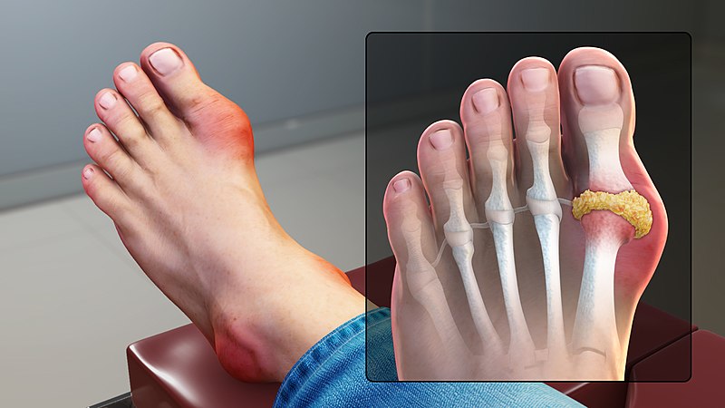 File:Gout Signs and Symptoms.jpg