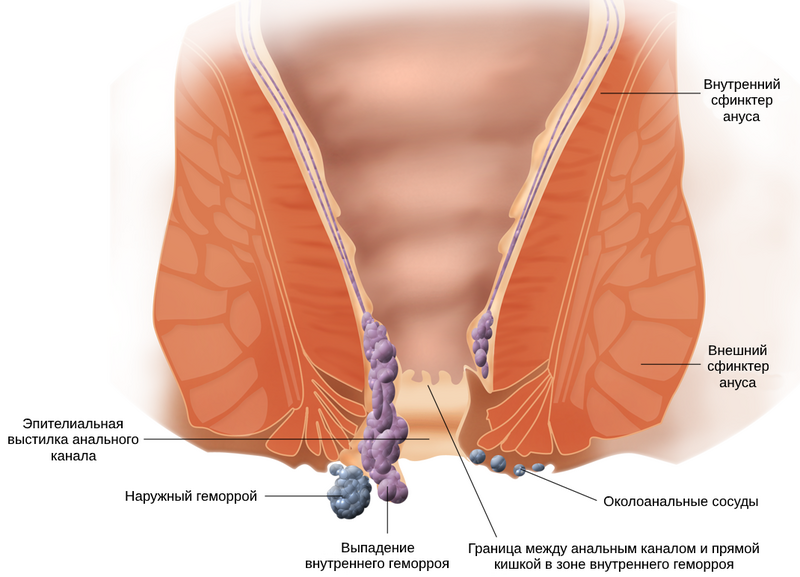 Наружный геморрой – методы лечения