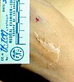 Long Beach Jane Doe scar.jpg